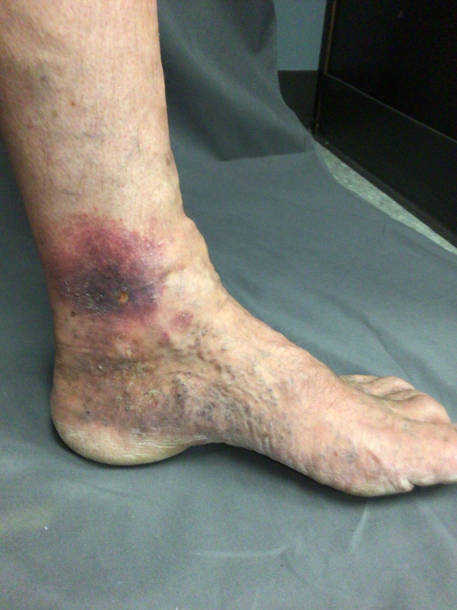 Venous Leg Ulcers